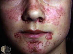 Waspada, Gejala Lupus pada Anak Lebih Gawat