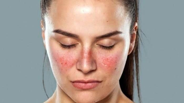 Anak Perempuan Lebih Rentan Terkena Lupus, Begini Alasannya